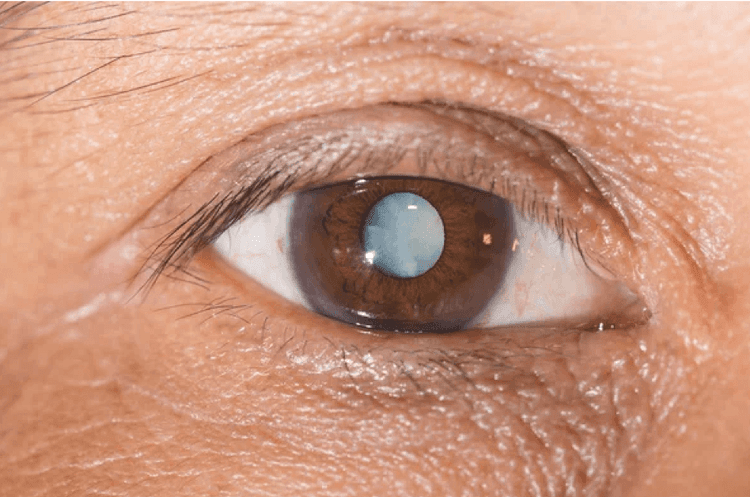 cataract surgery