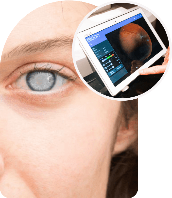 Laser Cataract Surgery