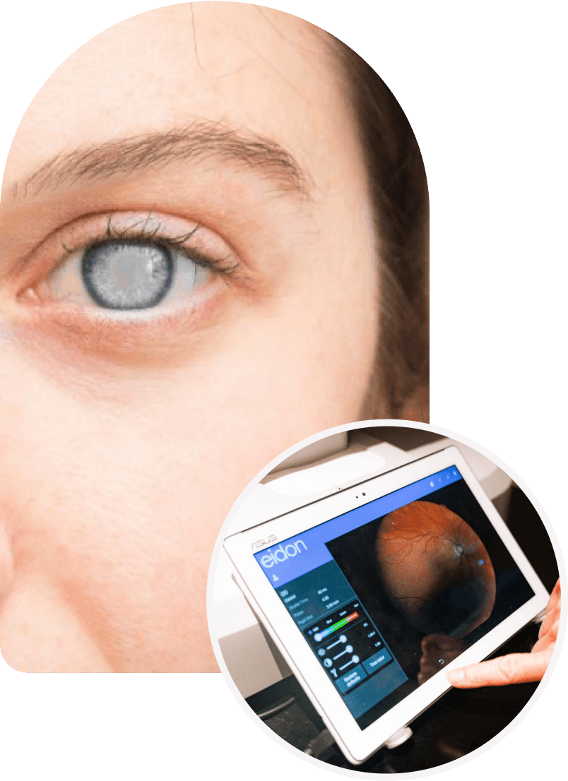 Laser Cataract Surgery