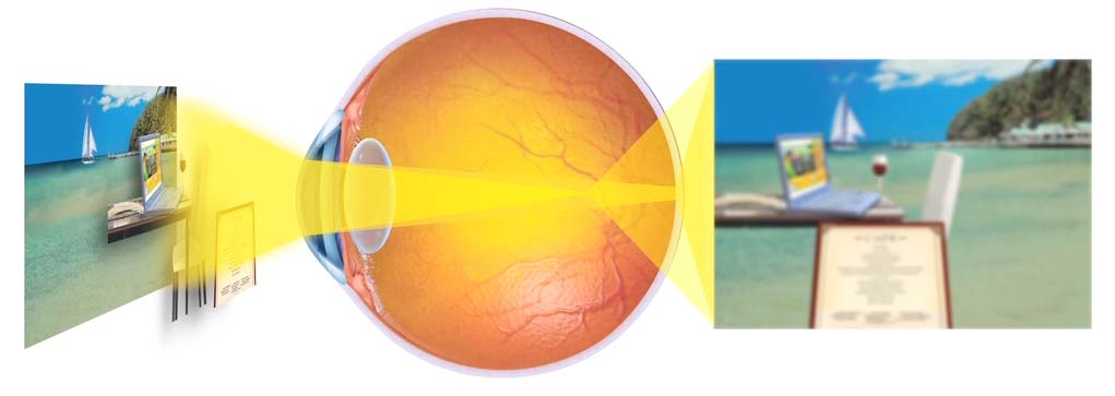 How Astigmatism Affects The Eye